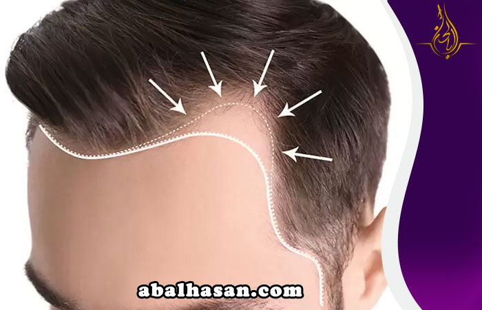 احدث الطرق لزراعة الشعر