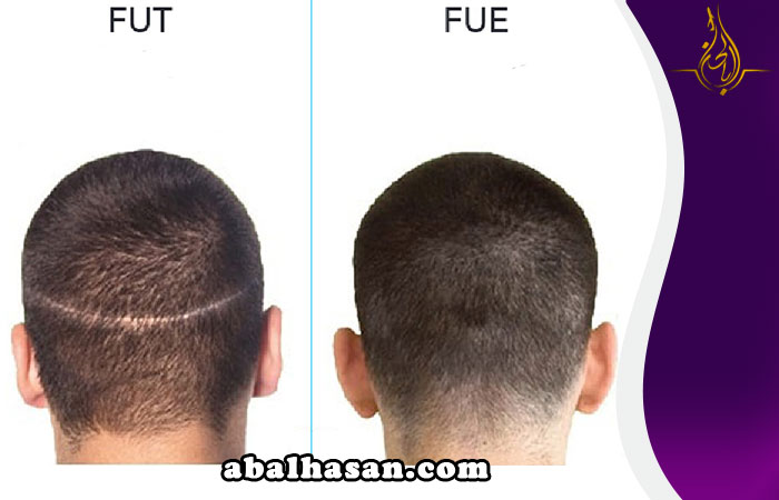 فائدة زراعة الشعر بطريقة FUE بدلاً من طريقة FUT