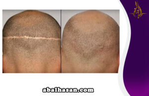 فائدة زراعة الشعر بطريقة FUE بدلاً من طريقة FUT