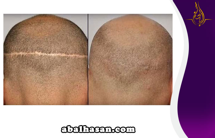 فائدة زراعة الشعر بطريقة FUE بدلاً من طريقة FUT