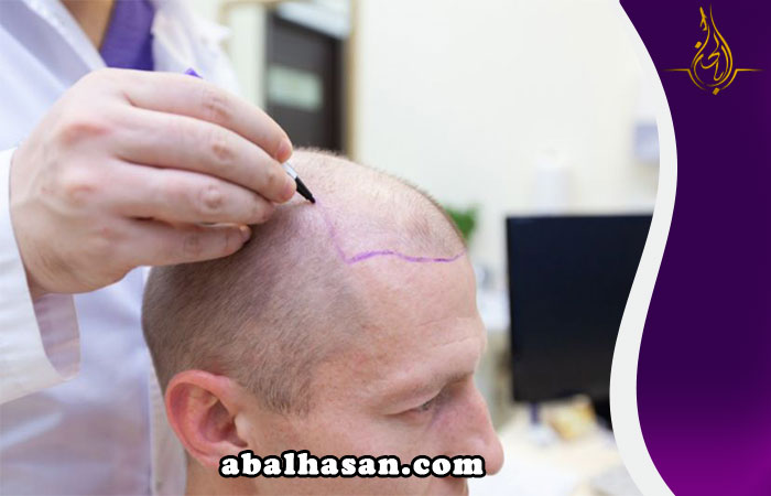 أضرار زراعة الشعر والاثار الجانبية