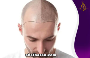 تجربة لزراعة الشعر مع ابوحسن في ايران