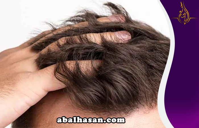 زراعة الشعر باستخدام تقنية fue