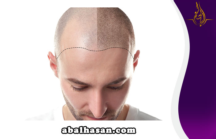 نصائح ما بعد عملية زراعة الشعر