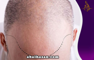 تجربة لزراعة الشعر مع ابوحسن في ايران