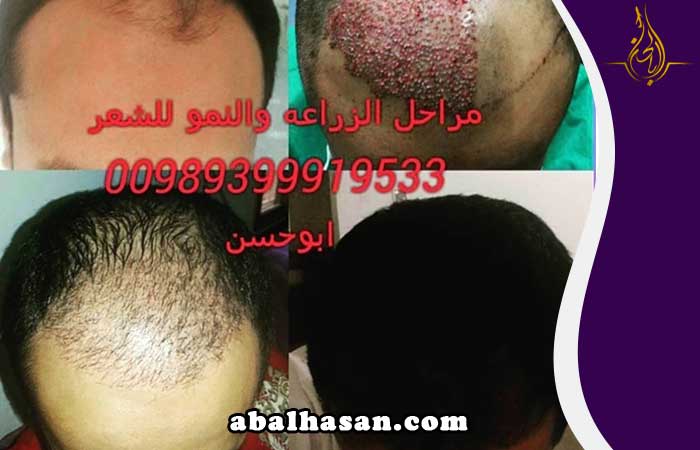 زراعة الشعر في شيراز