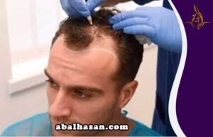 افضل مركز زراعة الشعر في شيراز