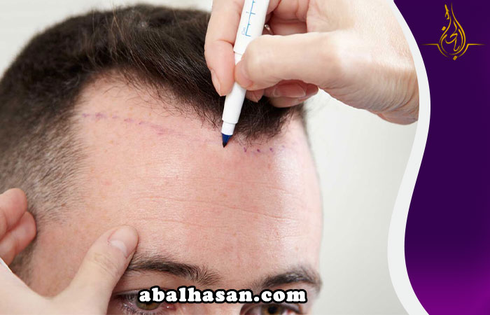 افضل عيادة لزراعة الشعر في السعوديه