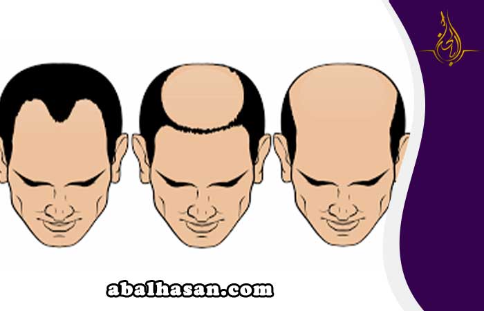 زراعة الشعر في مسقط