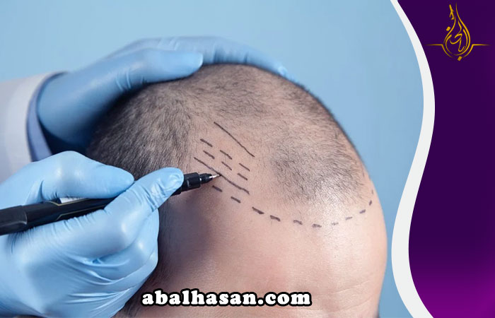 زراعة الشعر في طهران