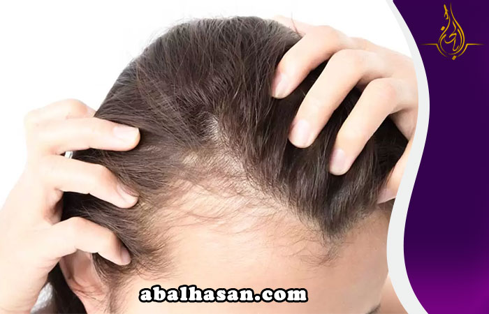 زراعة الشعر للنساء