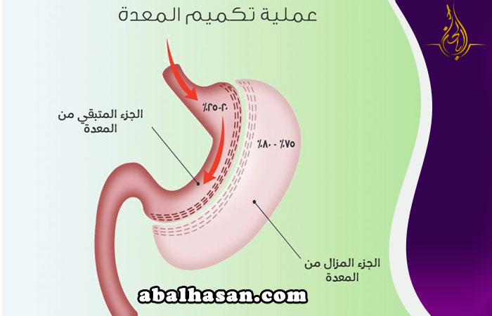 احجز الان لعملية تكميم المعده 