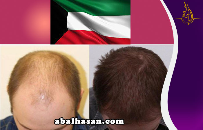 زراعة الشعر في الكويت