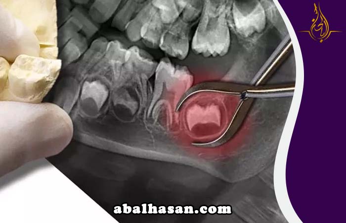 تكلفة خلع ضرس العقل جراحيا