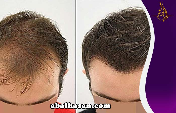 بكج زراعة الشعر في ایران مشهد