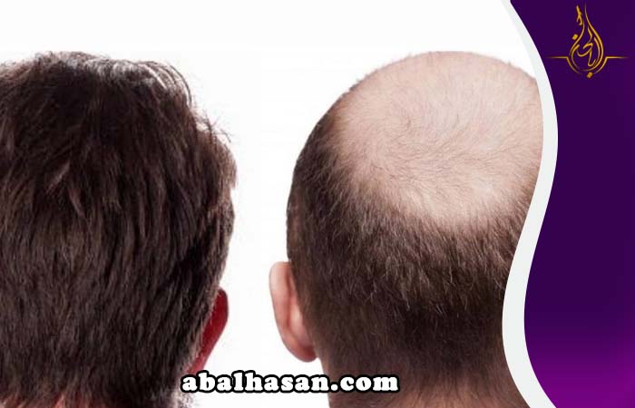 زراعة الشعر المتقدمة في ايران مشهد