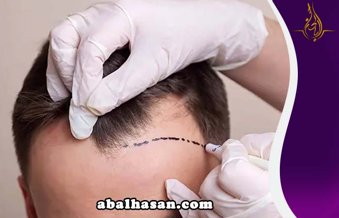 زراعة الشعر ايران مشهد