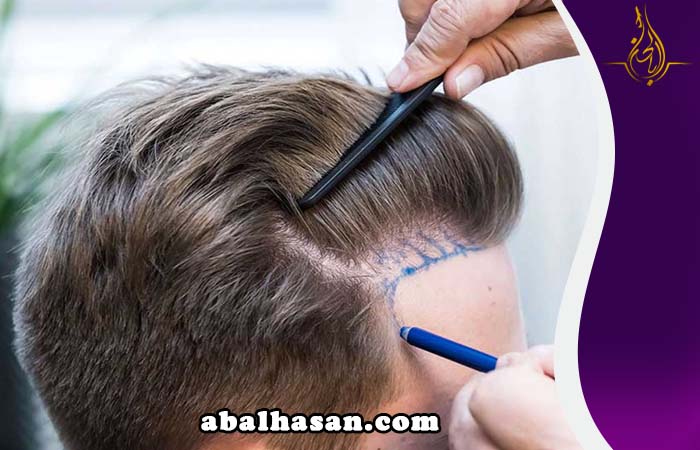 زراعة الشعر في عمان او شيراز