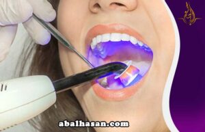 تبييض الاسنان بالليزر في ايران