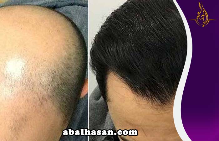 زراعة الشعر ساری