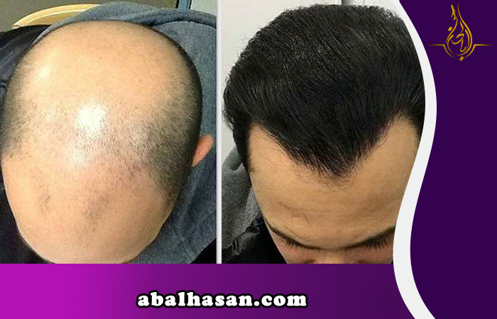 زراعة الشعر في ايران