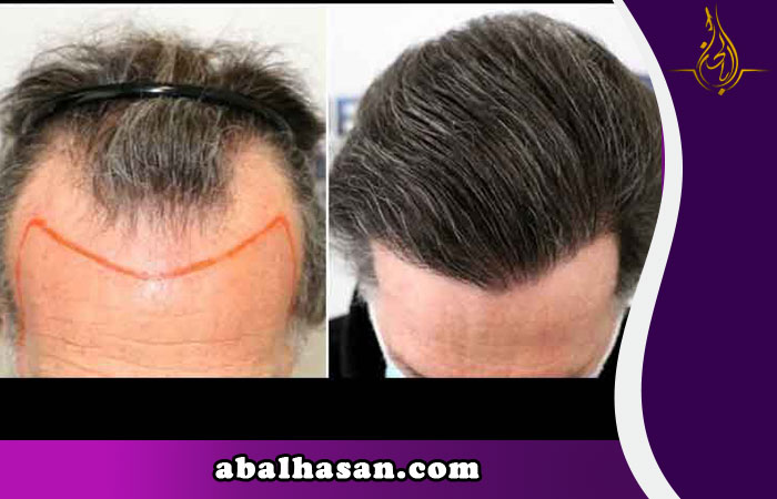 زراعة الشعر في ايران