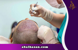 زراعة الشعر في ايران