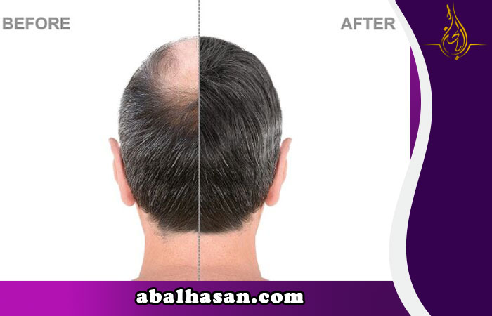 زراعة الشعر في ايران