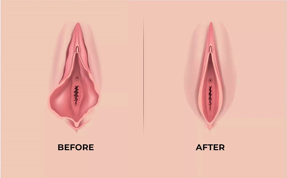 تجميل الشفرات في الكويت