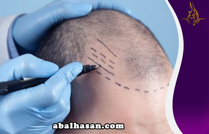 زراعة الشعر في قم المقدسة