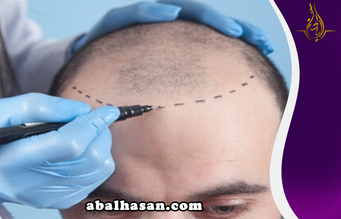 زراعة الشعر في قم المقدسة